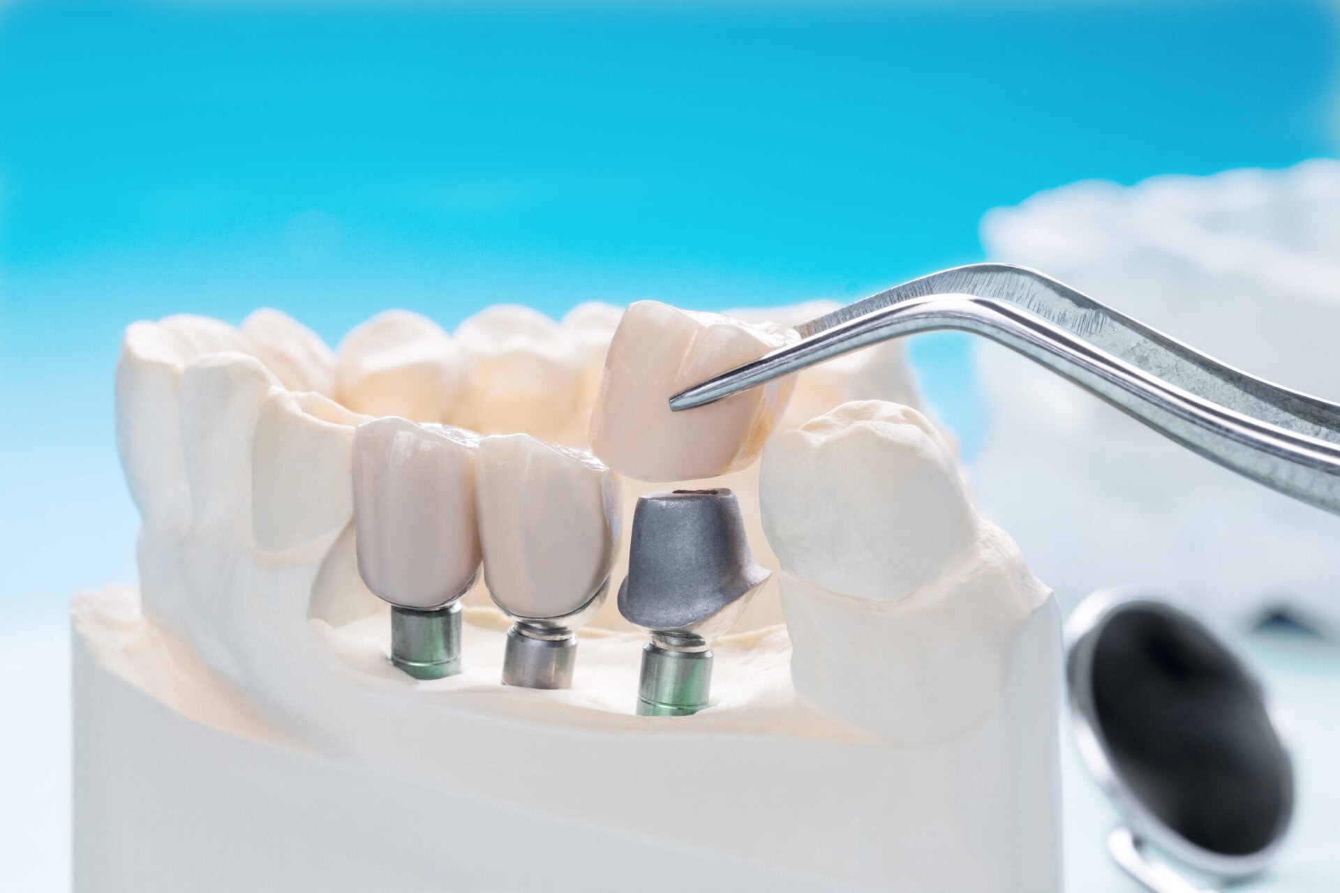 Kron ve implant taşıyan çene modeli, yanında el aletleri