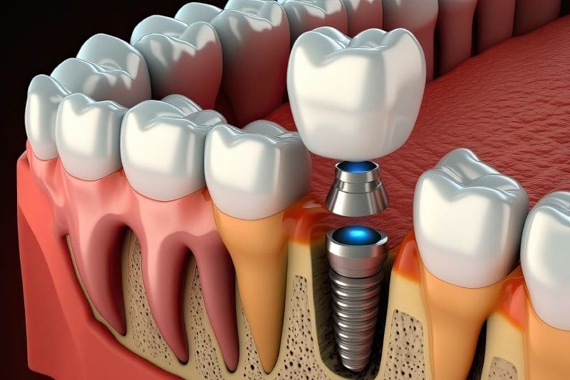 Kesit çizimi: çene kemiğine yerleşmiş implant ile komşu diş kökleri
