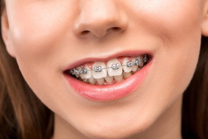 Üst ve alt çeneye takılmış metal braketlerin ve telin yakın çekimi