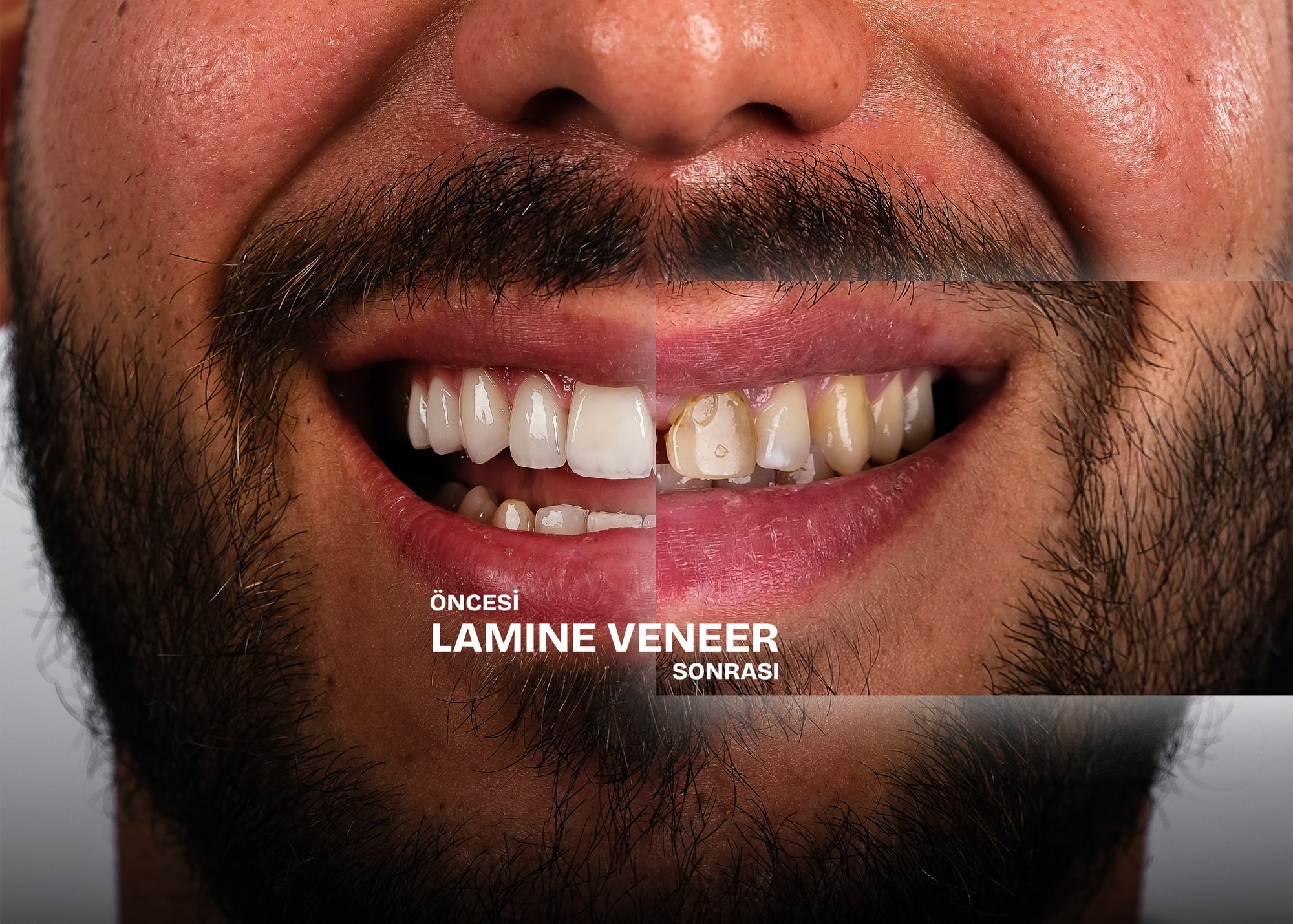 Lamine veneer öncesi ve sonrası: aynı gülüşün iki hali yan yana