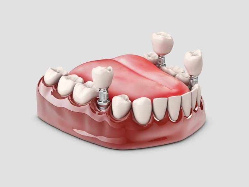 Alt çene modelinde vidalı diş implantı ve üzerine oturan kron, üç boyutlu görsel