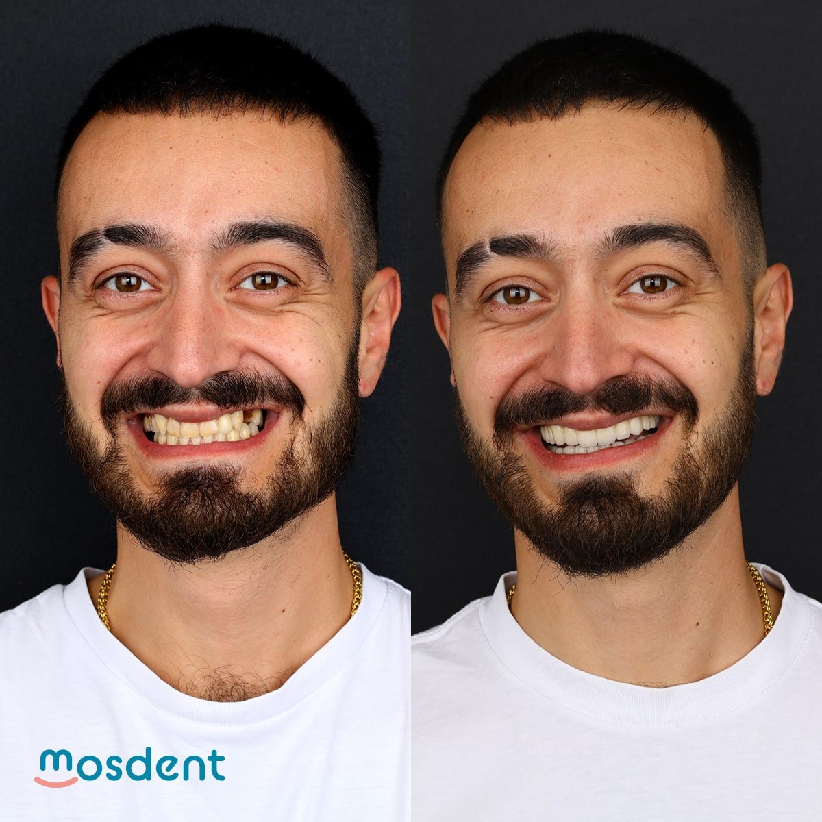 holywood-smile-gallery-8