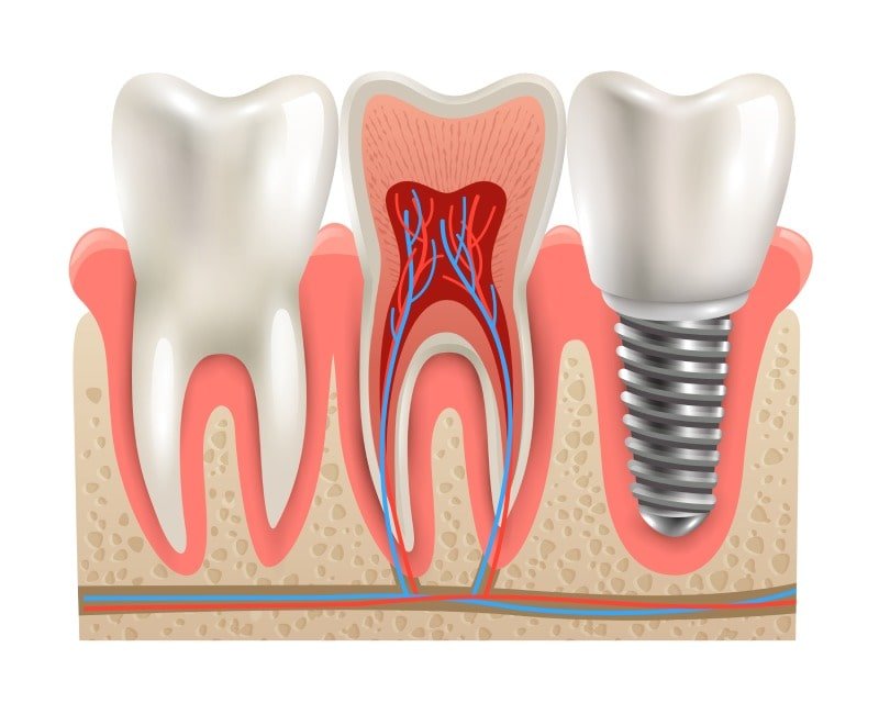 all on four implant