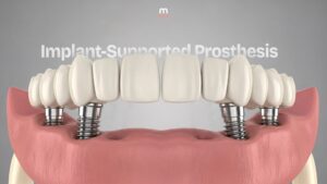 İmplant Destekli Protezler