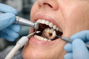 Diş Kökü Çürüğü Nedir? Kök Çürükleri Nasıl Tedavi Edilir?
