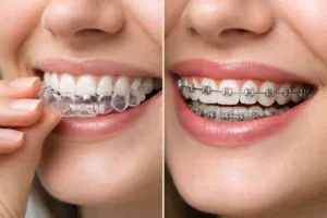 Invisalign mi Diş Teli mi?