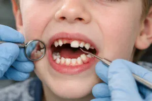 Süt Dişleri Zamanından Önce Kaybedilirse Ne Olur?