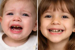 Biberon Çürüğü ve Çocuklarda Siyah Diş Lekeleri