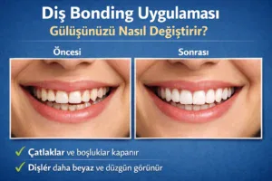 Diş Bonding Uygulaması Gülüşünüzü Nasıl Değiştirir?