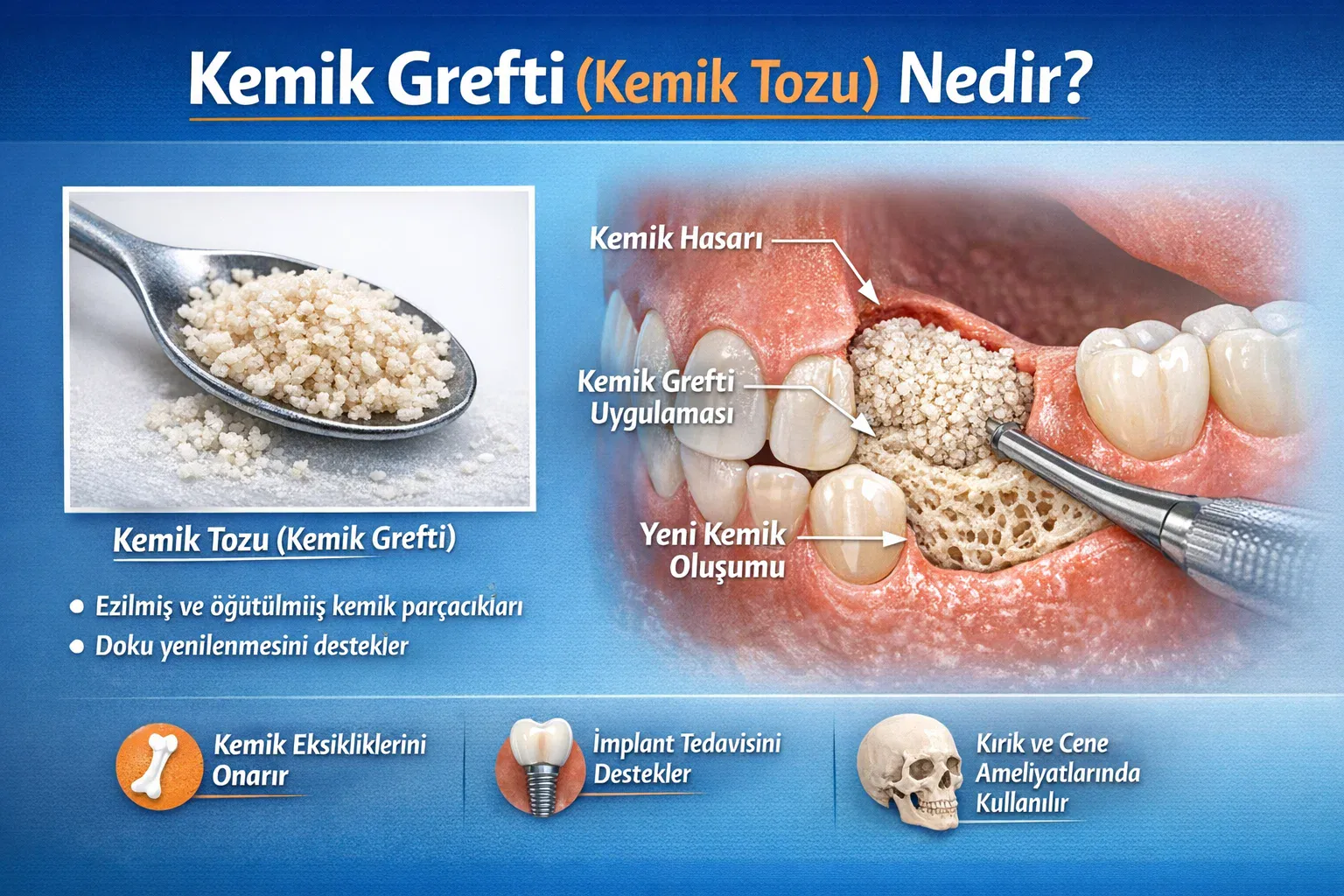 Kemik Grefti (Kemik Tozu) Nedir?
