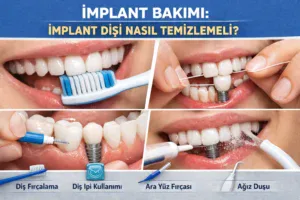 İmplant Bakımı: İmplant Dişi Nasıl Temizlemeli?